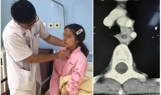 Cô gái Hải Phòng phải nhập viện vì miếng thịt bò mắc kẹt ở 1/3 thực quản