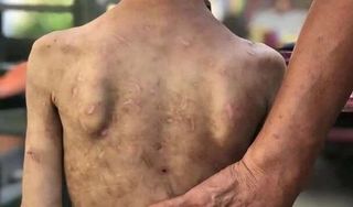 Bà dùng dây cáp đánh, dùng kìm bấm chằng chịt lên người cháu 7 tuổi