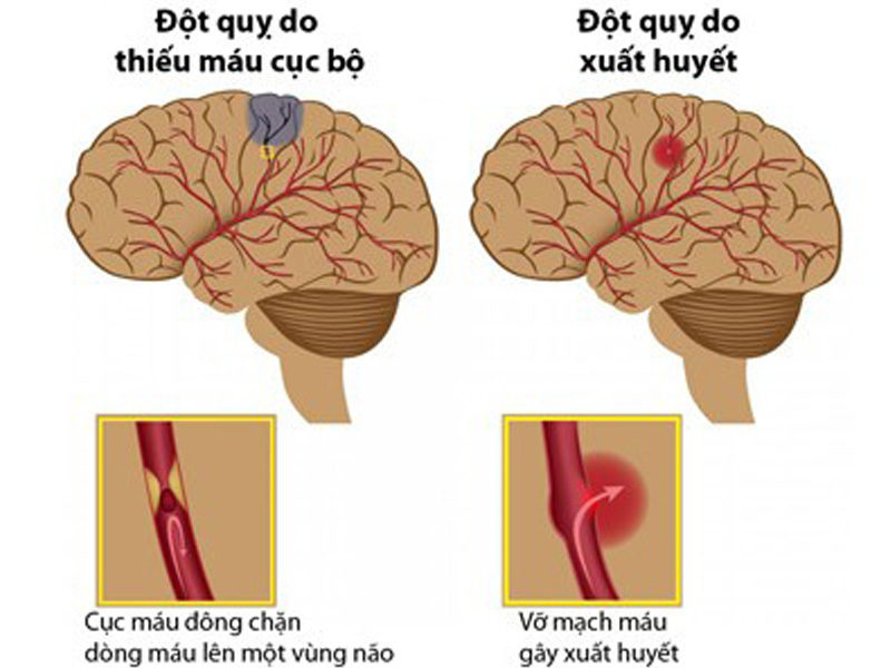 Phân loại tai biến mạch máu não