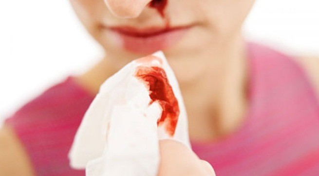 Màu nước mũi đỏ là do vỡ mao mạch nhỏ trong mũi