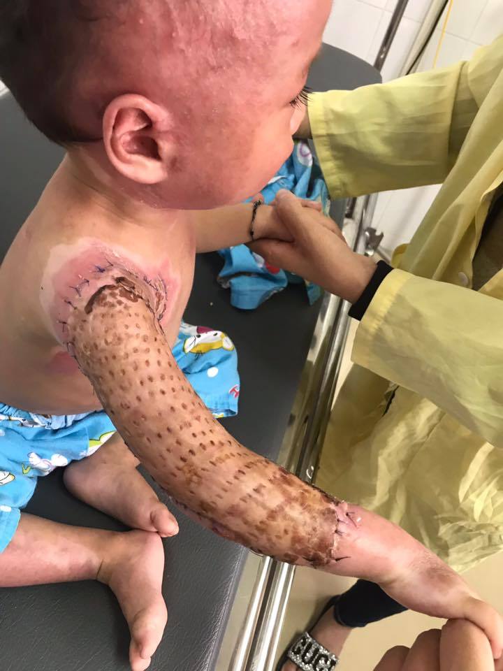Quảng Ninh: Bé trai 2 tuổi bị bỏng nước sôi toàn thân 2