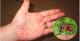 Bé trai 10 tuổi tử vong nghi do sốt xuất huyết