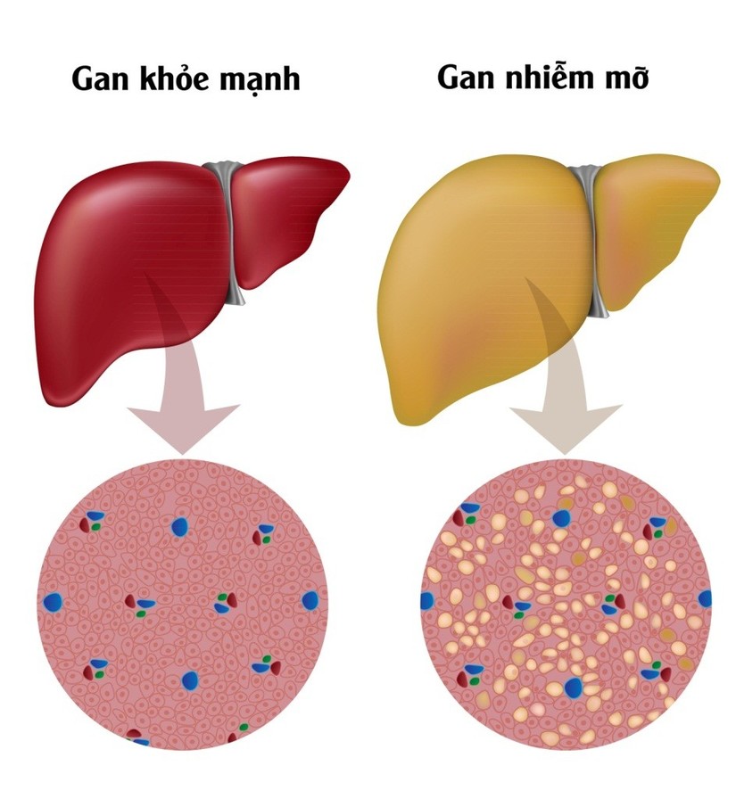 Quá trình tích tụ mỡ trong gan gây ra gan nhiễm mỡ không do rượu