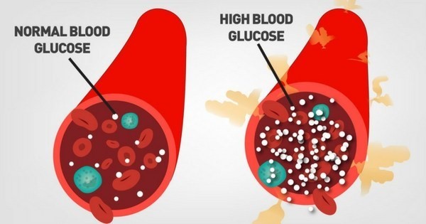 Đái tháo đường cũng là nguy cơ gây gan nhiễm mỡ không do rượu