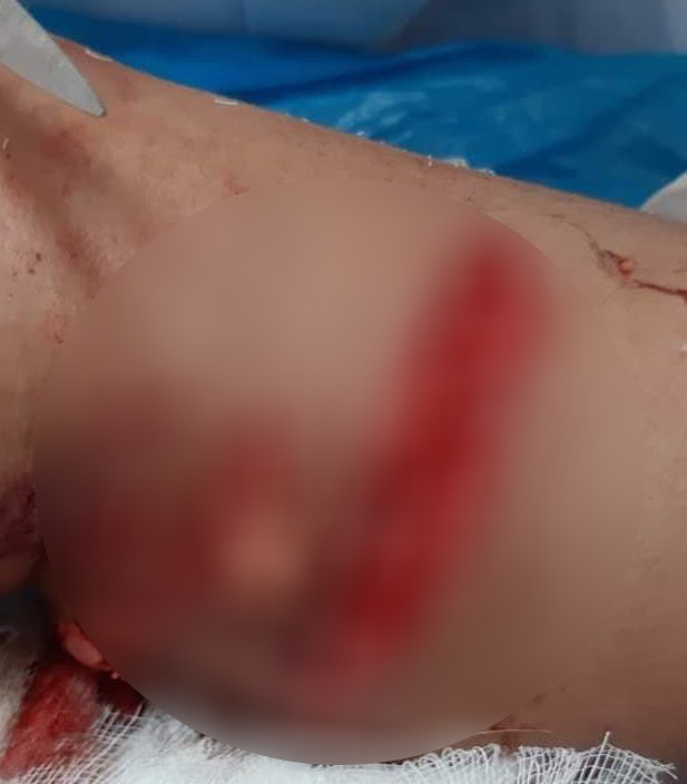 Bé 7 tuổi bị chó cắn lộ gân cẳng chân ở Phú Thọ