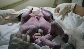 Nghẹt thở cứu hai bé song sinh dính liền nhau ở Quảng Nam