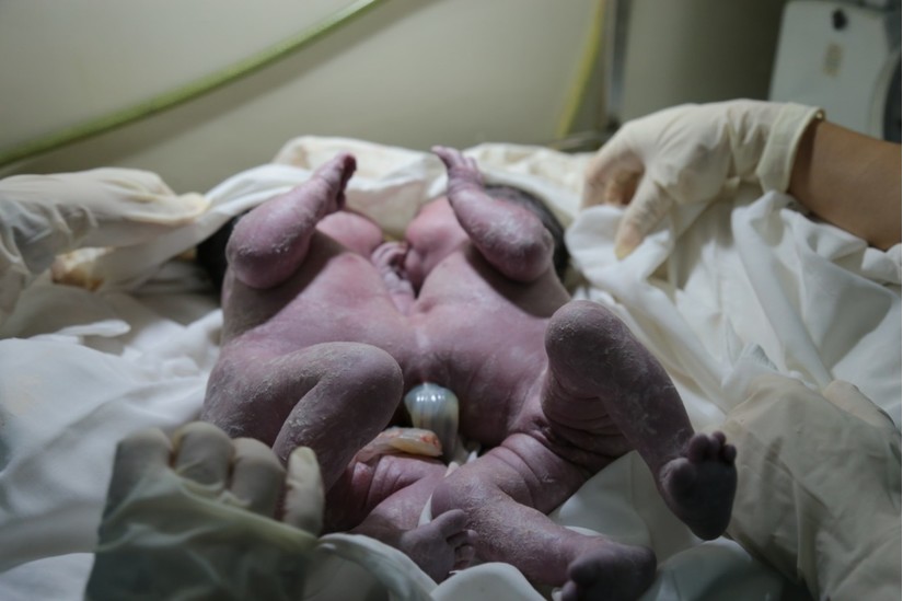 Hành trình nghẹt thở cứu hai bé song sinh dính liền nhau ở Quảng Nam