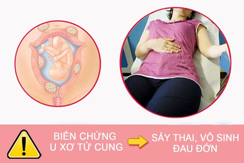 u xơ tử cung