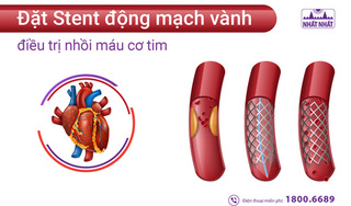 Đặt Stent động mạch vành điều trị nhồi máu cơ tim