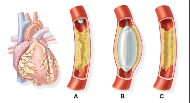 đặt stent động mạch vành