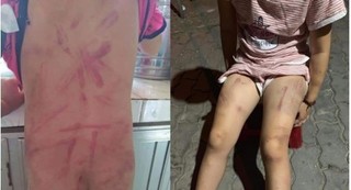 Tiết lộ nguyên nhân bất ngờ khiến bé gái 6 tuổi bị bà cố đánh bầm tím người