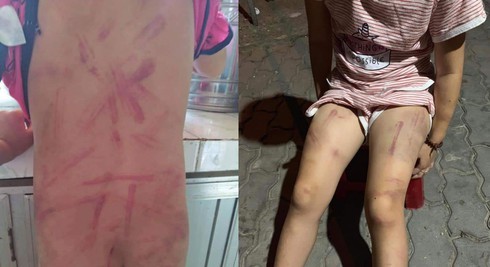 Nguyên nhân bất ngờ khiến bé gái 6 tuổi bị bà cố đánh bầm tím người