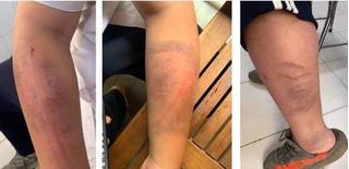 Bé trai 13 tuổi ở Hà Nội 'tố' bị bố đánh dã man vì viết chữ xấu