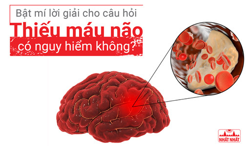 thiếu máu não có nguy hiểm không