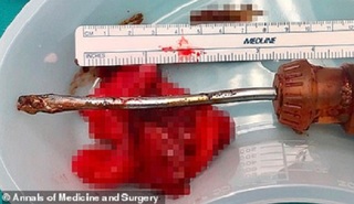 Đau đớn dữ dội suốt một tuần, phát hiện tuốc nơ vít dài 21cm trong cơ thể