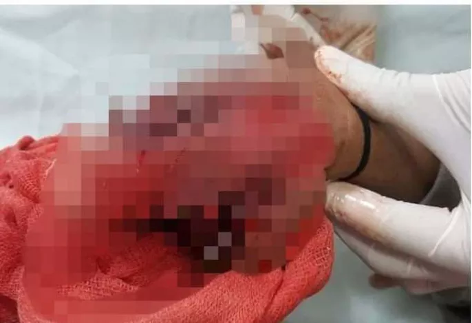 Thanh Hóa: Đèn pin phát nổ khiến một cháu bé phải cắt cụt bàn tay