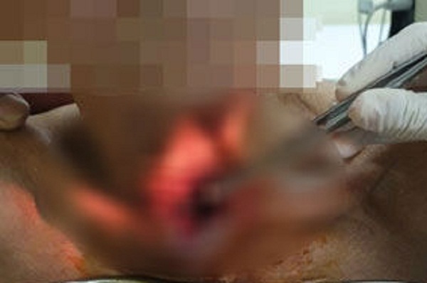 Tá hỏa 30 con giòi làm tổ trong cổ bệnh nhân 78 tuổi