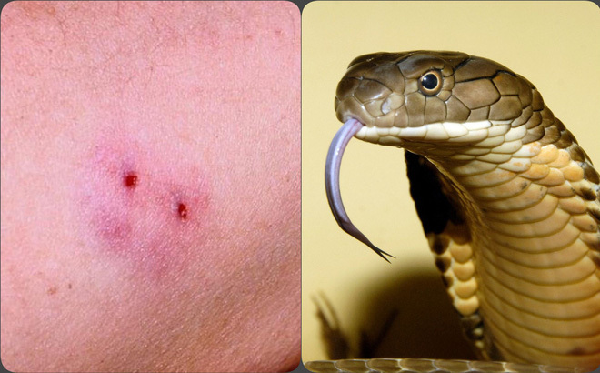 Cảnh báo tự hút nọc độc sau khi rắn cắn tác hại khó lường