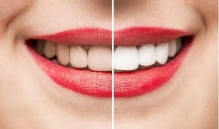 Những nguy hại khó lường khi tẩy trắng răng
