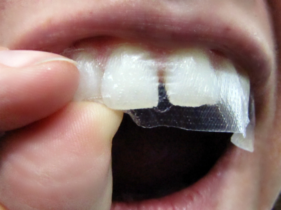 Miếng dán trắng răng có tác dụng 'thần kỳ' như quảng cáo?