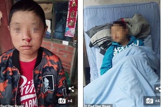 Bé trai 12 tuổi mắc chứng bệnh sợ ánh nắng, chảy máu không ngừng như ma cà rồng