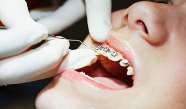 Răng xô lệch, tái phát sau khi tháo mắc cài niềng răng do đâu?