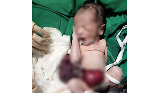 Nghệ An: Cháu bé mới sinh đã bị rơi toàn bộ nội tạng ra ngoài