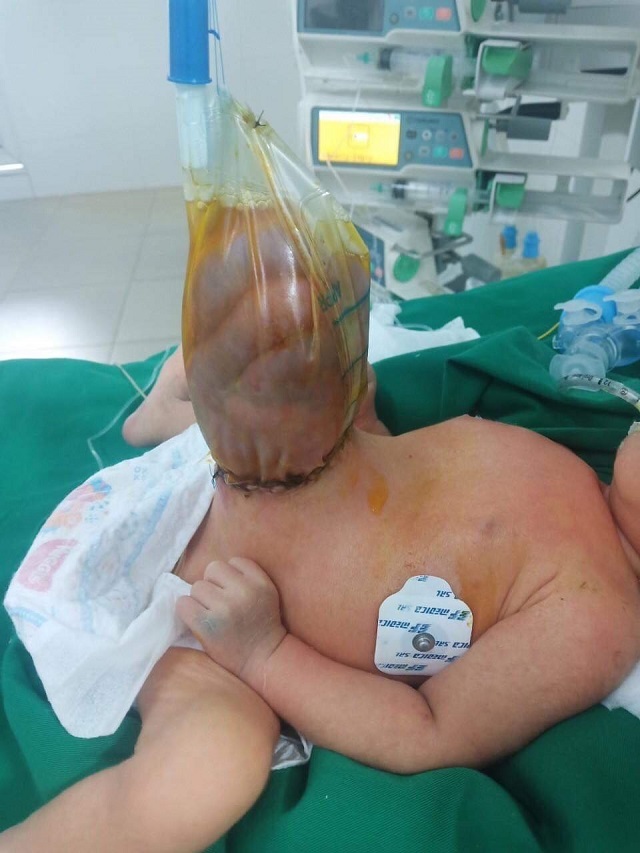 Nghệ An: Cháu bé mới sinh đã bị rơi toàn bộ nội tạng ra ngoài 2