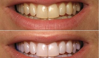 Tẩy trắng răng dịp cuối năm giá bao nhiêu?