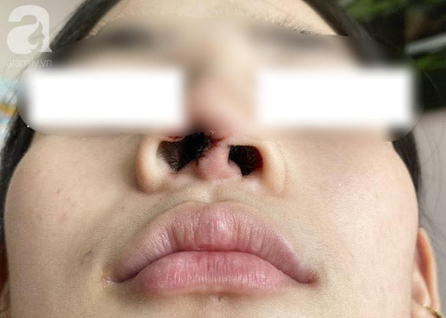 Thiếu nữ 16 tuổi biến dạng mũi khi phẫu thuật thẩm mỹ ở spa