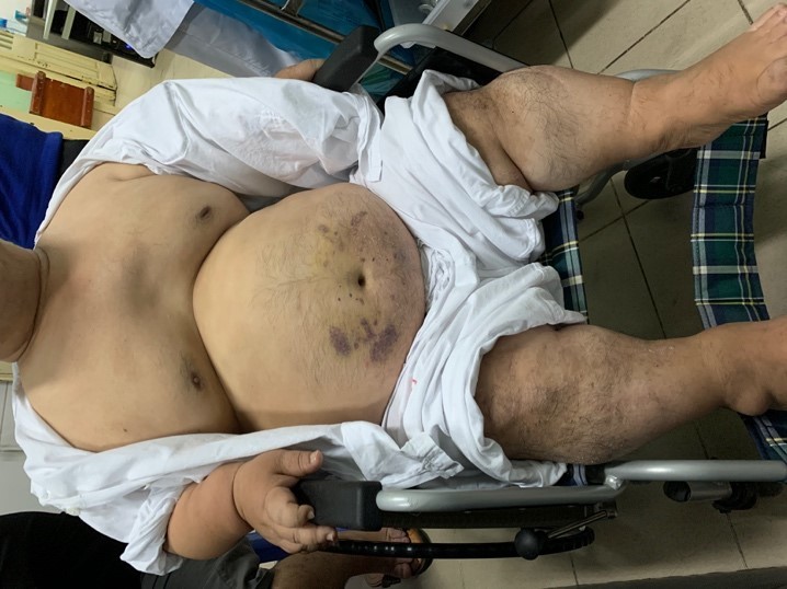 Ca can thiệp tim mạch 'chưa từng có' cho người đàn ông cao 120m, nặng 60kg ở Nam Định