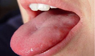 Vết nhiệt lâu khỏi là dấu hiệu thường gặp bẹnh ung thư lưỡi 
