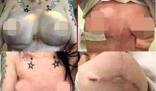 Nâng ngực với giá hơn 150 triệu đồng, cô gái phải cắt bỏ 2 bên vú