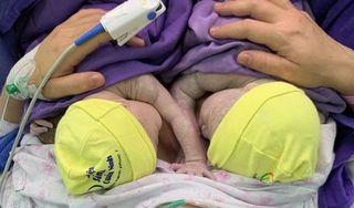 Quảng Ninh: Cặp sinh đôi chào đời trong bọc ối 