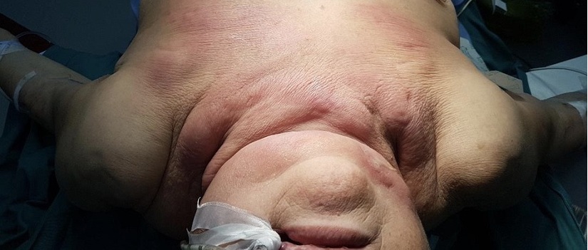 Cụ bà ở Nam Định bị nhiễm khuẩn hút ra hàng trăm ml mủ dưới hàm