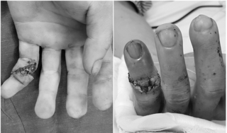 Các bác sĩ Quảng Ninh lần đầu nối thành công đốt ngón tay đứt lìa cho bệnh nhân bị tai nạn