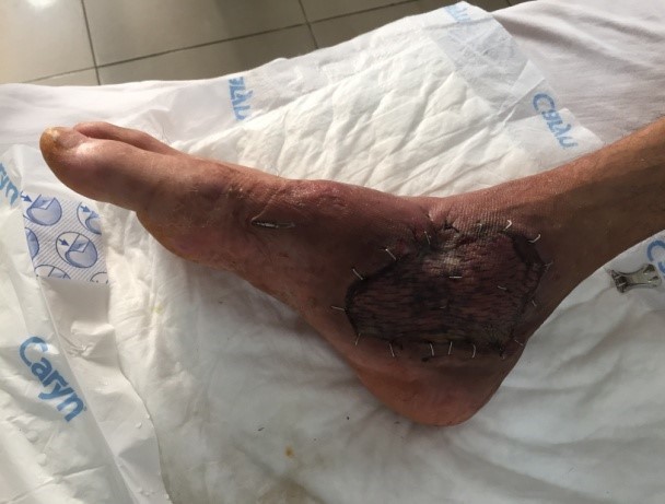 Ngại đi bệnh viện, người đàn ông Nam Định suýt mất chân vì tự điều trị tại nhà
