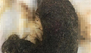 Phát hiện khối u tóc lớn trong dạ dày bé gái 11 tuổi tại Hà Nội