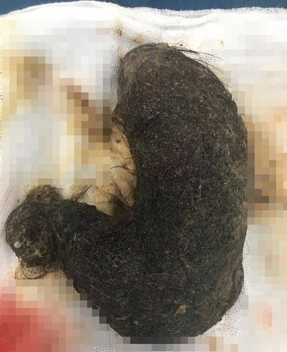Phát hiện khối u tóc lớn trong dạ dày bé gái 11 tuổi tại Hà Nội
