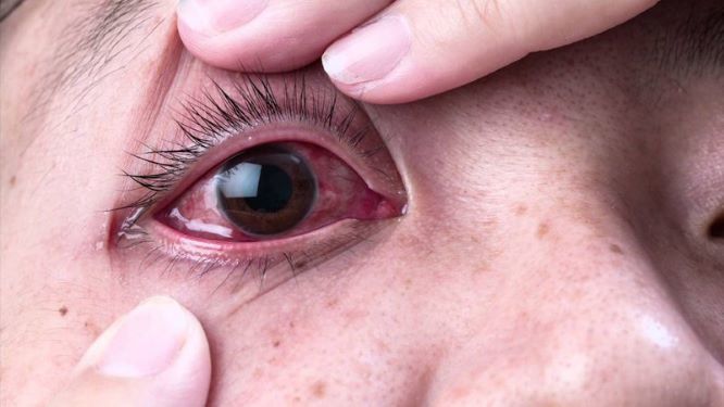 Virus corona có thể tồn tại trong mắt người tới 20 ngày