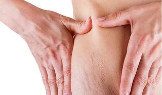 Cách chữa rạn da hiệu quả tại nhà