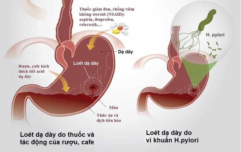 viêm loét dạ dày