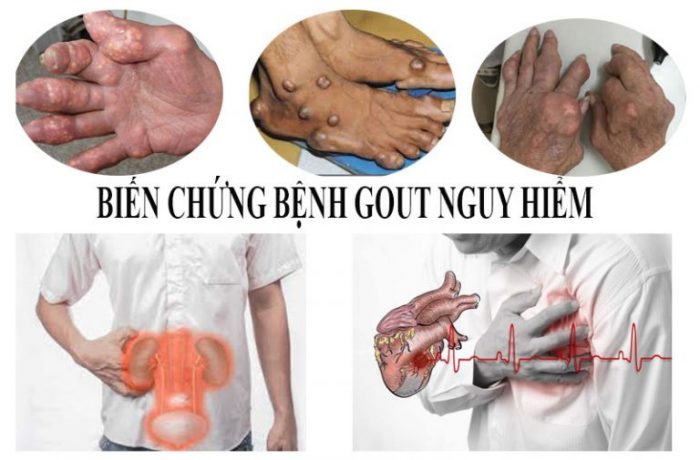 nguoi-bi-benh-gut-gout-nen-kieng-an-13-thuc-pham-nay