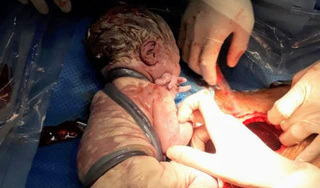 Phẫu thuật kịp thời cứu cháu bé bị 6 vòng dây rốn quấn chặt cổ