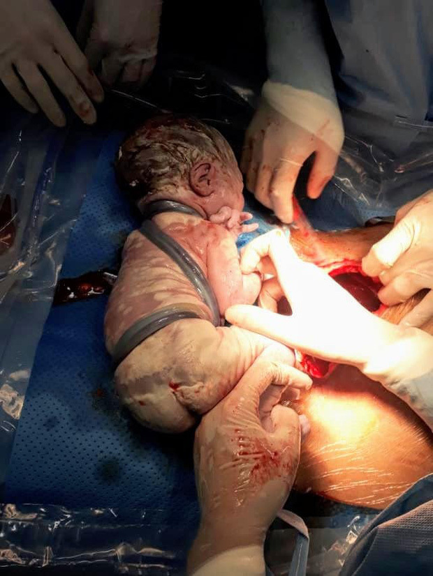 Phẫu thuật thành công bé bị 6 vòng dây rốn quấn chặt cổ ra đời