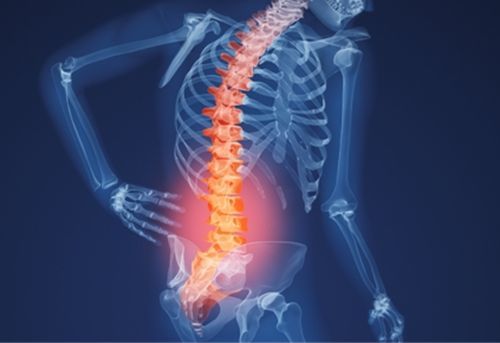 Cảnh báo những triệu chứng thoái hóa cột sống thắt lưng