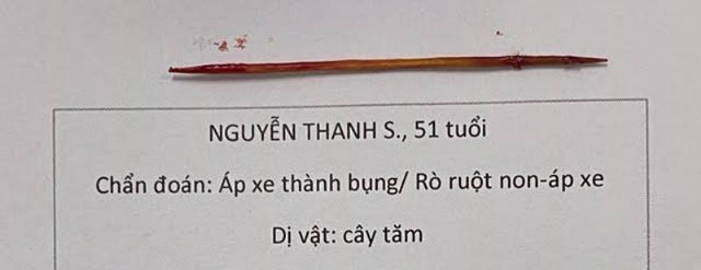 Người đàn ông bị tăm xỉa răng đâm thủng ruột và thành bụng