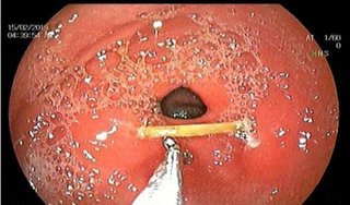 Người đàn ông bị tăm xỉa răng đâm thủng ruột và thành bụng