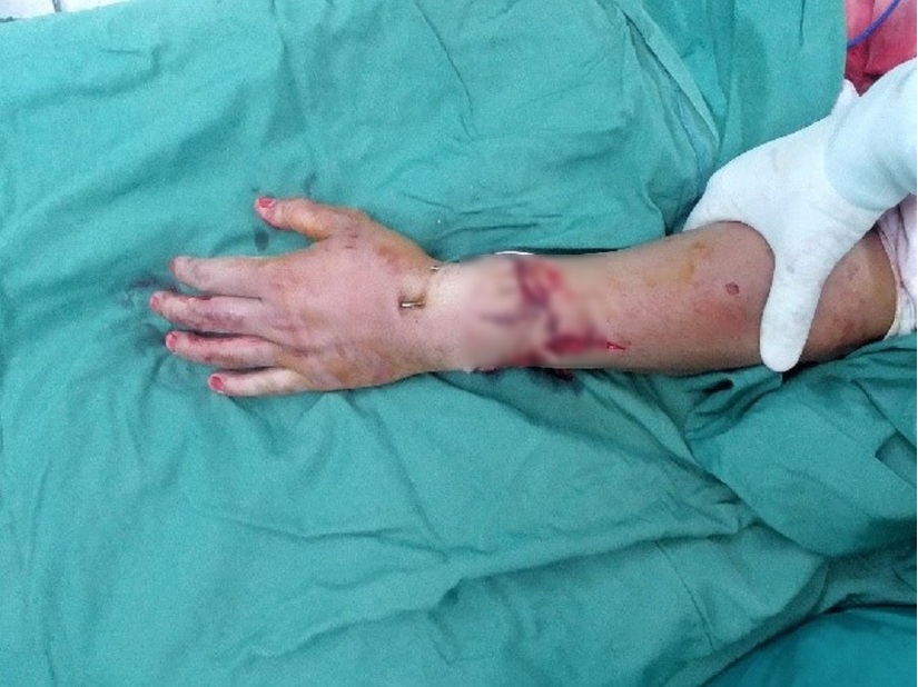 Phẫu thuật thành công cánh tay bị chém lìa sau va chạm 