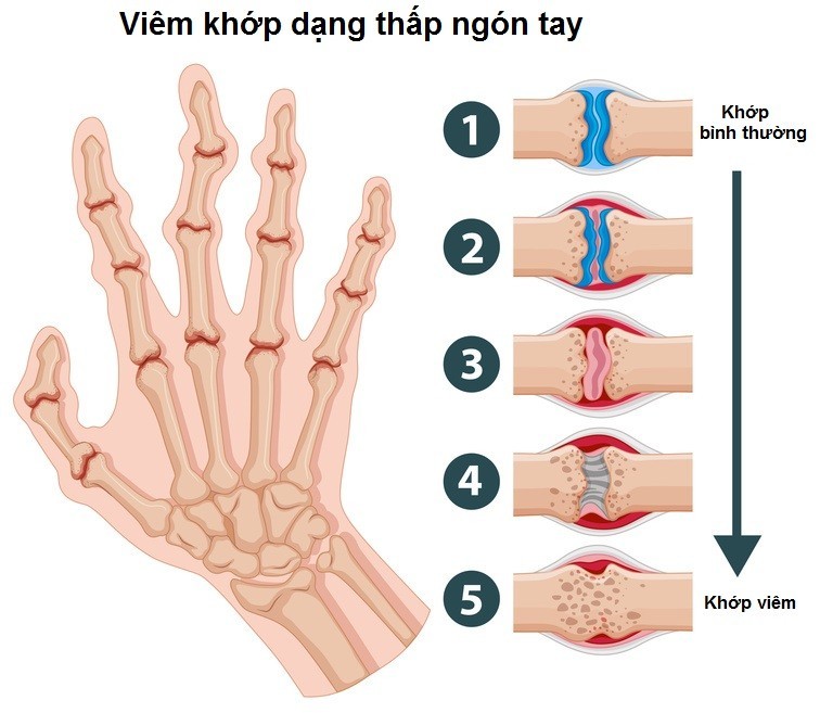 đau khớp ngón tay